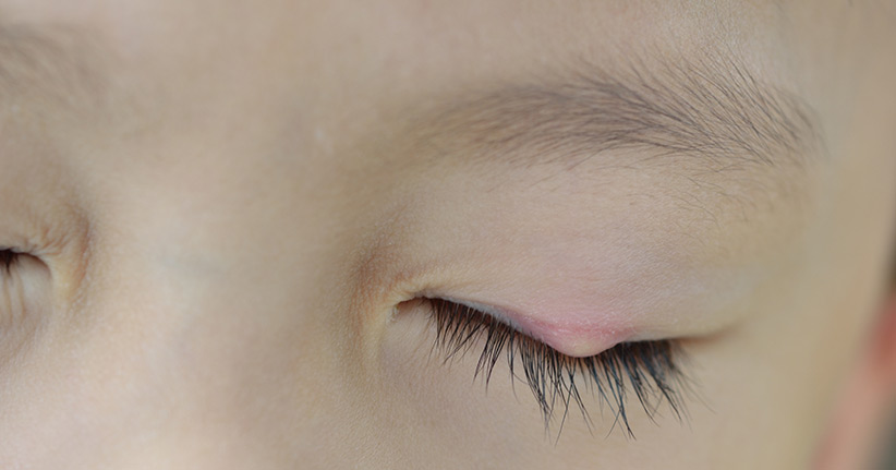 Welche Hausmittel helfen beim Gerstenkorn?