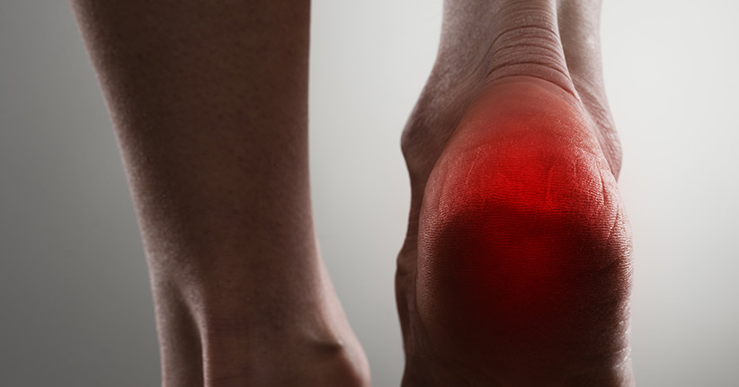 Fersensporn – eine schmerzhafte Volkserkrankung am Fuß