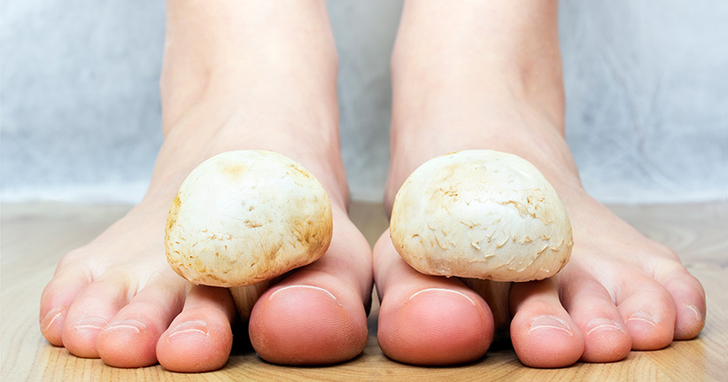 Hautpilz – Arten und Behandlung der Dermatomykose, Hautmykose