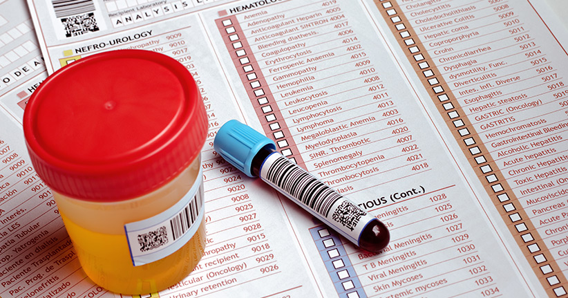 Gallengangkrebs Früherkennung – Urintest bringt Gewissheit