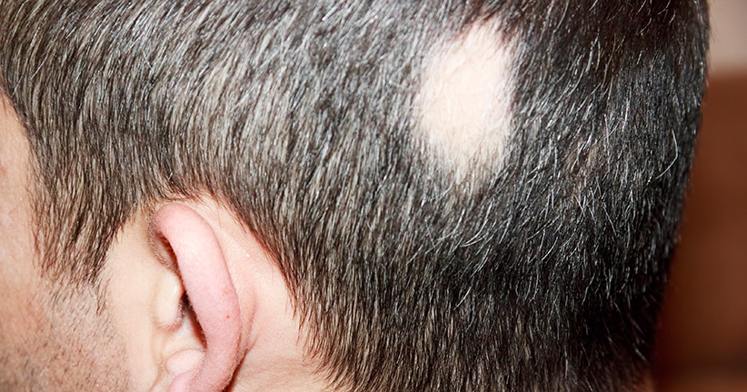 Kreisrunder Haarausfall – nicht nur ein kosmetisches Problem