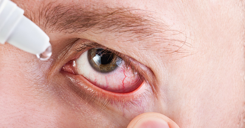 Was hilft gegen trockene Augen?