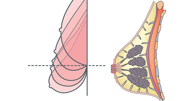 Bruststraffung – für ein neues, besseres Lebensgefühl