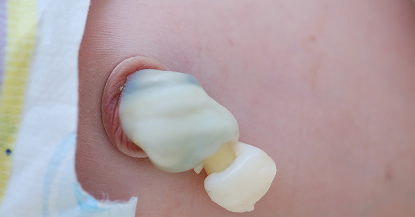 Nabelschnurblut aufbewahren kann Leben retten