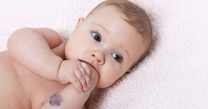 Kindliches Hämangiom – mehr als ein kosmetisches Problem?