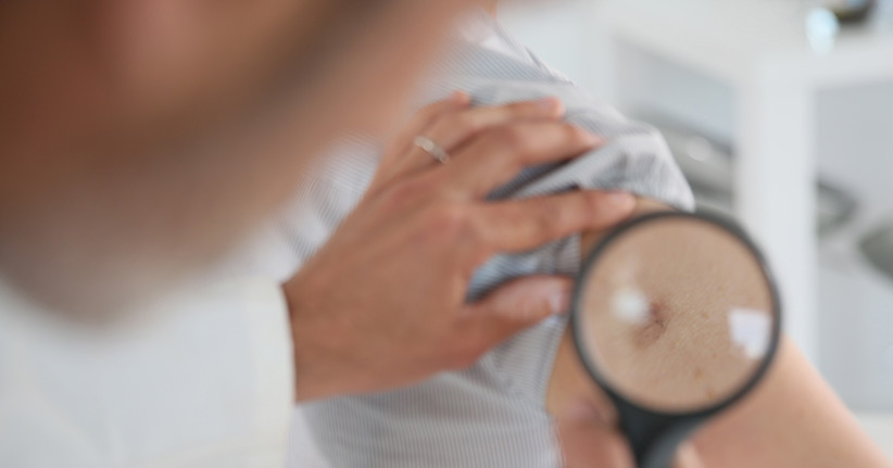 Wie Sie Hautkrebs erkennen können